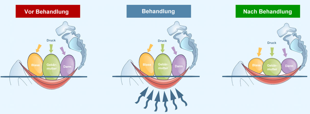 Inkontinenz Bonn